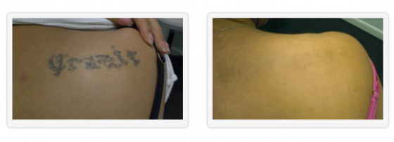 Unwanted Tattoos - Tattoo Removal Gallery